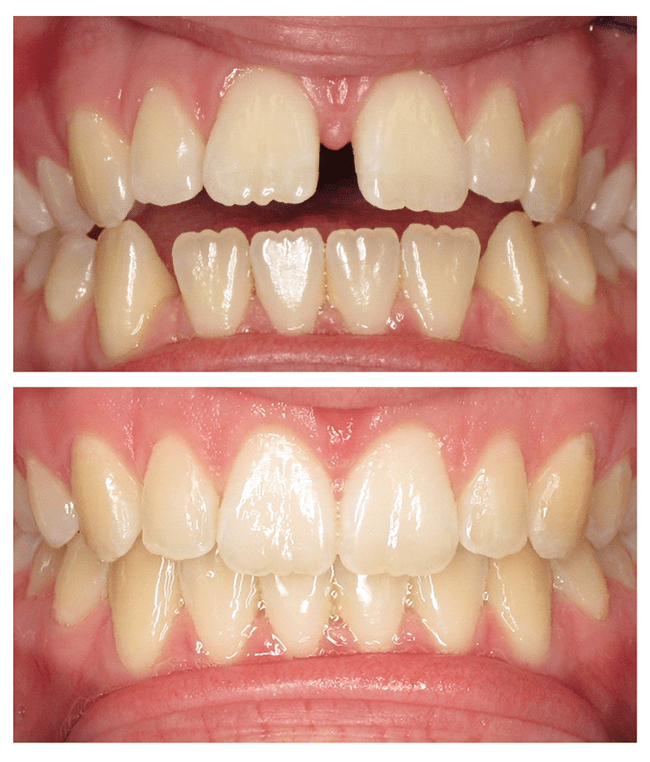 axel-invisalign-before-after